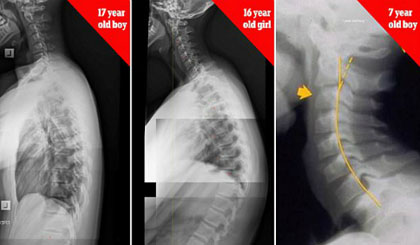  Xương sống của bé trai 17 tuổi, bé gái 16 tuổi và bé trai 7 tuổi bị biến dạng do nghiện thiết bị điện tử. Ảnh: James Carter.