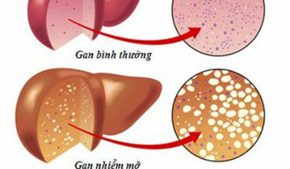 So sánh gan khỏe và gan nhiễm mỡ.