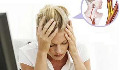 Đau đầu là triệu chứng rối loạn hoạt động não bộ, tăng nguy cơ đột quỵ.