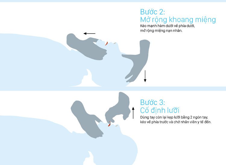 Dùng tay kẹp lưỡi bằng 2 ngón tay, kéo về phía trước.