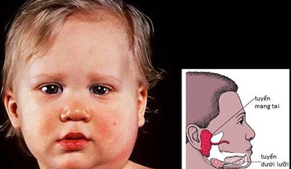 Trẻ bị quai bị, tuyến dưới hàm sẽ sưng phồng lên.