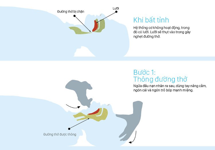Khi bất tỉnh, hệ thống cơ không hoạt động, trong đó có lưỡi. Lưỡi sẽ thụt vào gây nghẹt đường thở.