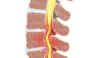 Tùy vào vị trí ống sống (màu vàng) bị hẹp ở đâu sẽ gây bệnh lý hẹp ống sống ở đó. Ảnh: Bác sĩ Võ Xuân Sơn.